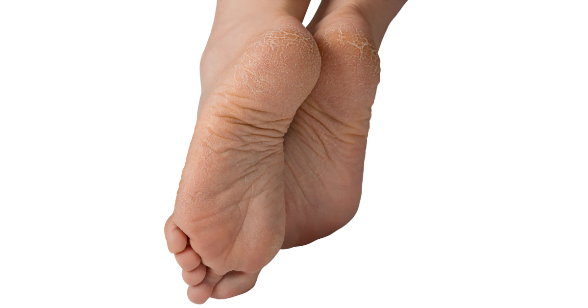 Pęknięcia pięt sucha skóra